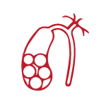 Cholesterol gallstones